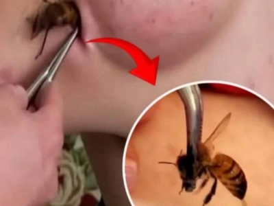 Dr. Pimple Popper’s Weekly Story: Grapefruit Sized Lipoma