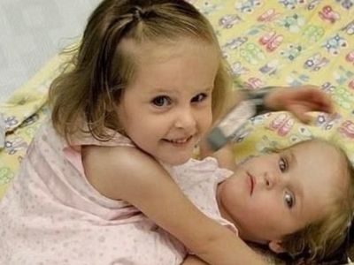 These Conjoined Twins Were Separated at the Age of 4: What is Their Life Like Today?