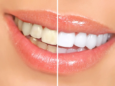 How Does Professional Teeth Whitening Work? | Dr. Rick Dentistry