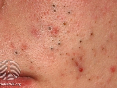 Acne | NHS inform
