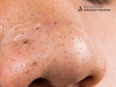 Say Goodbye To Blackheads: 7 Powerful Treatments That Work