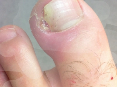 How to Treat an Ingrown Toenail at Home: Tips and Natural Remedies