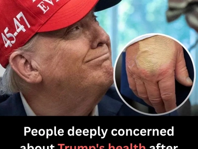 People deeply concerned about Trump’s health after new photo reveals ‘amount of foundation’ on hand